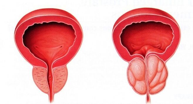 Surunkali prostatit bilan sog'lom va yallig'langan prostata
