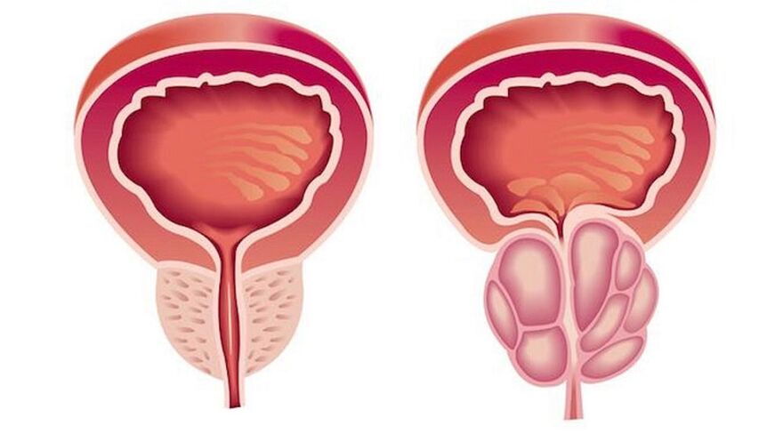 Prostatit bilan sog'lom va yallig'langan prostata